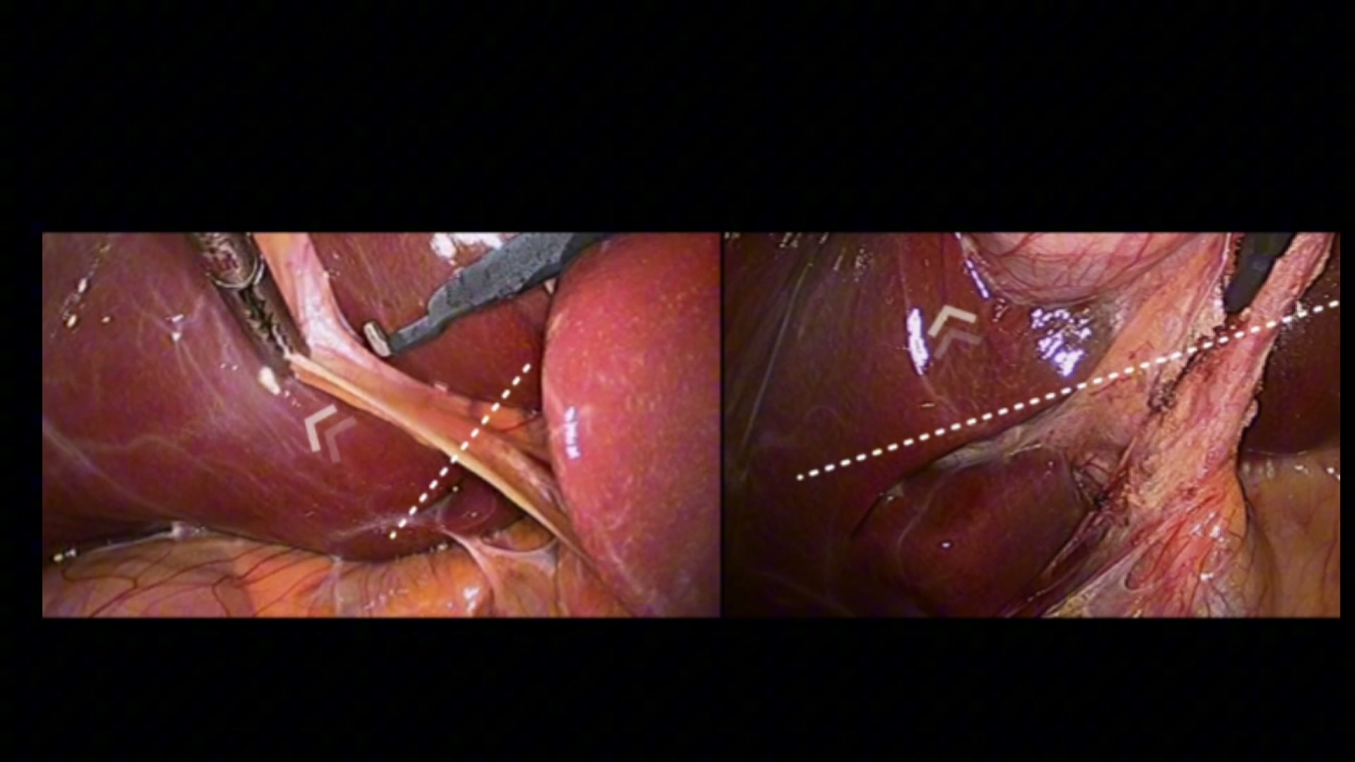 Two laparoscopic camera views side by side with dissection planes marked