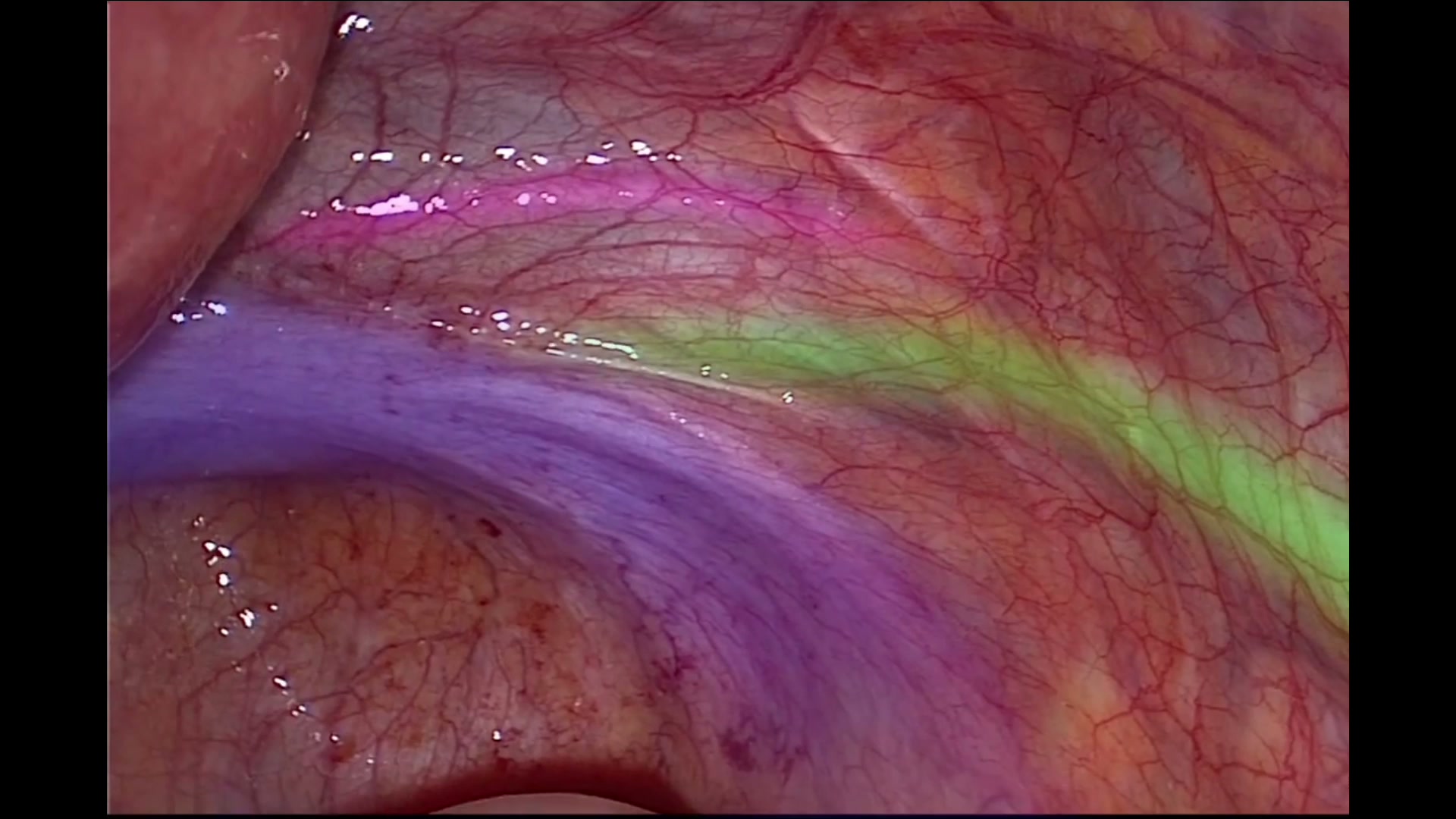 Laparoscopic view with anatomical structures segmented in colour by the LapSx overlay