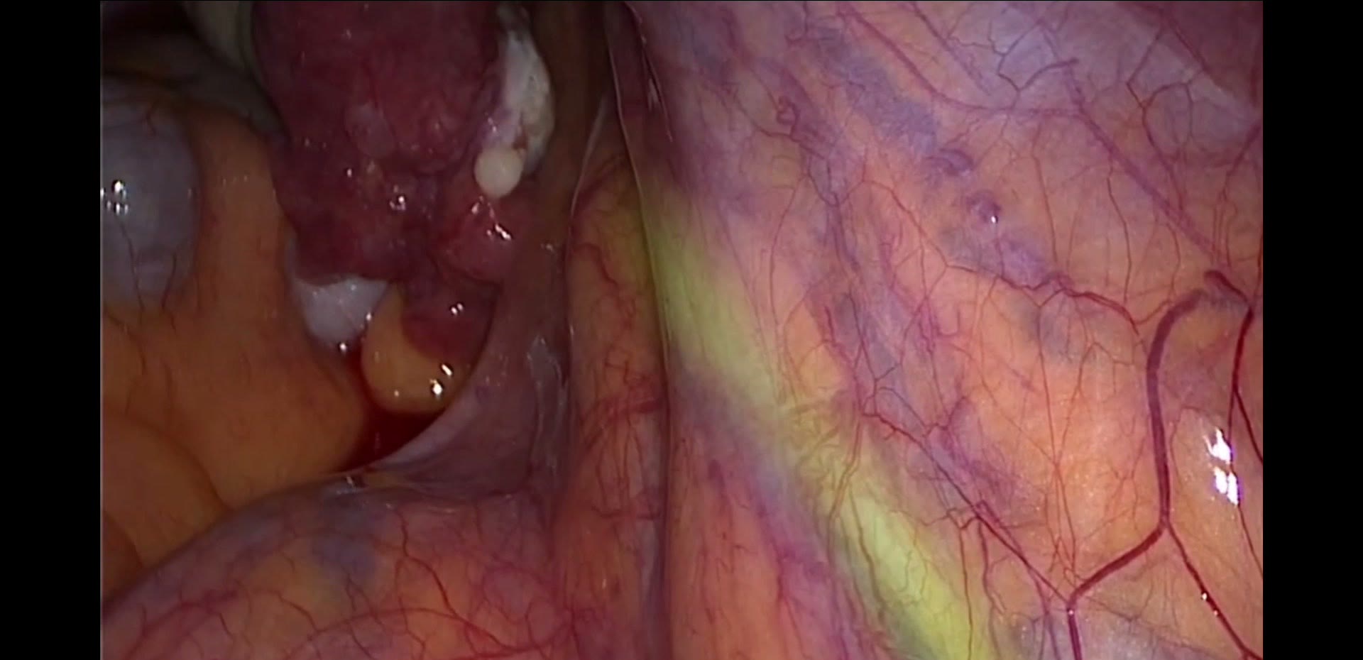 Live laparoscopic feed with the right ureter highlighted by the LapSx AI overlay